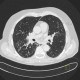 Terminal bronchiolitis, tree-in-bud: CT - Computed tomography